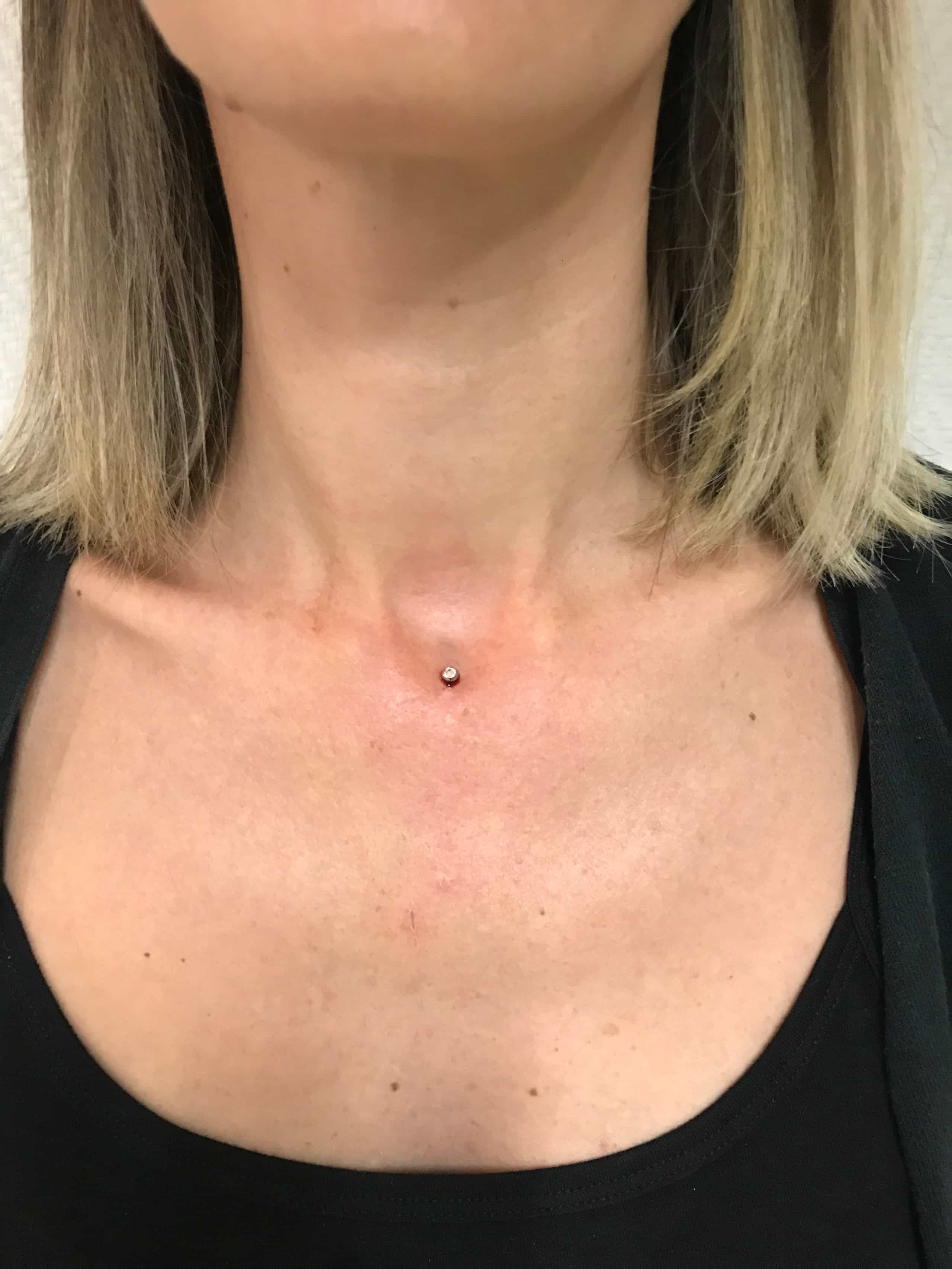 Une personne aux cheveux mi-longs avec un piercing dermal sur le haut de la poitrine, visible au-dessus d'un haut noir, réalisé par Nadia au salon de piercing à Bastia (Bastia Tattoo).